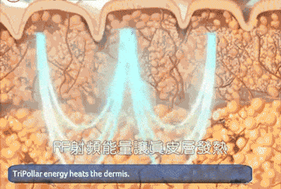 射頻刺激膠原.gif